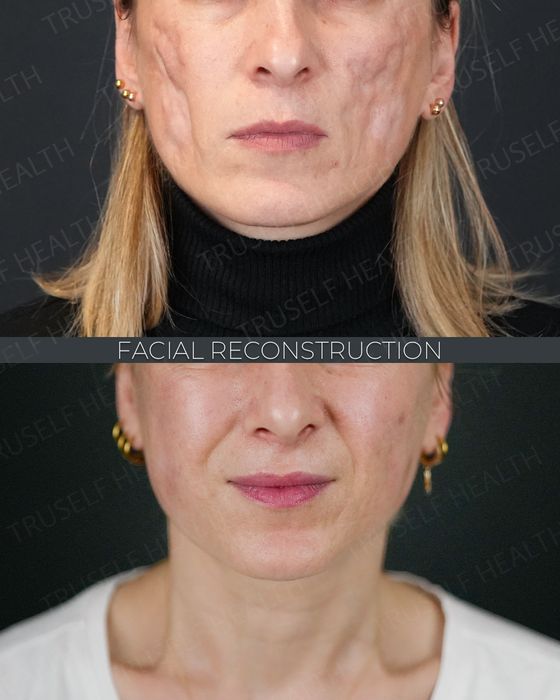 Facial Rejuvenation before and after