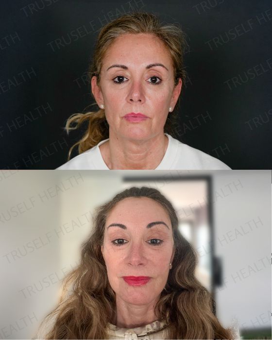 Facial Rejuvenation before and after