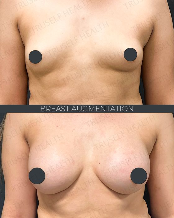 Breast Surgery before and after
