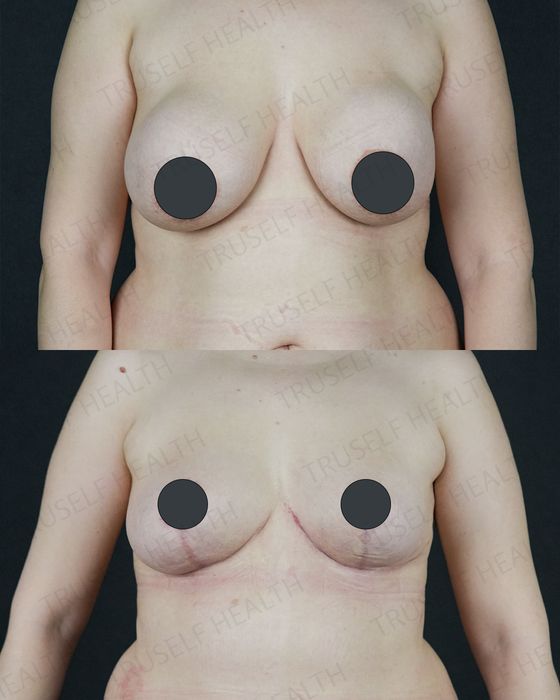 Breast Surgery before and after