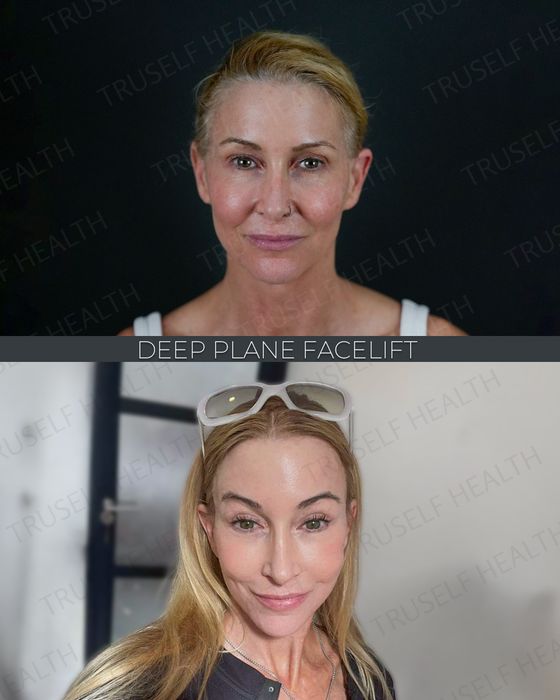 Facial Rejuvenation before and after