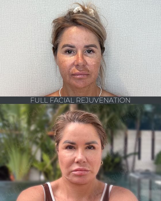 Facial Rejuvenation before and after