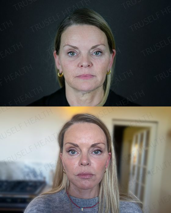 Facial Rejuvenation before and after