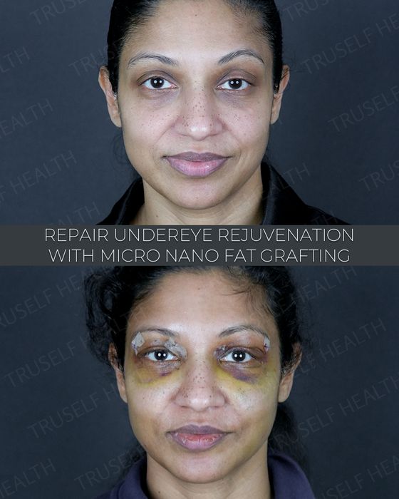 Eyelid & Brow before and after