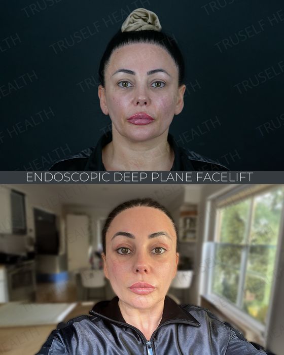Facial Rejuvenation before and after
