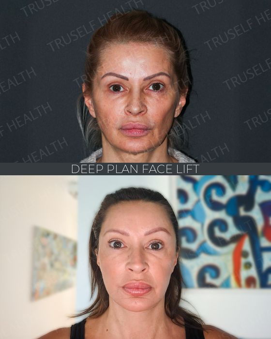 Facial Rejuvenation before and after