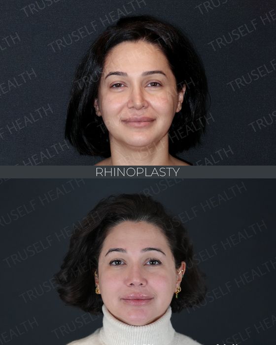 Rhinoplasty before and after