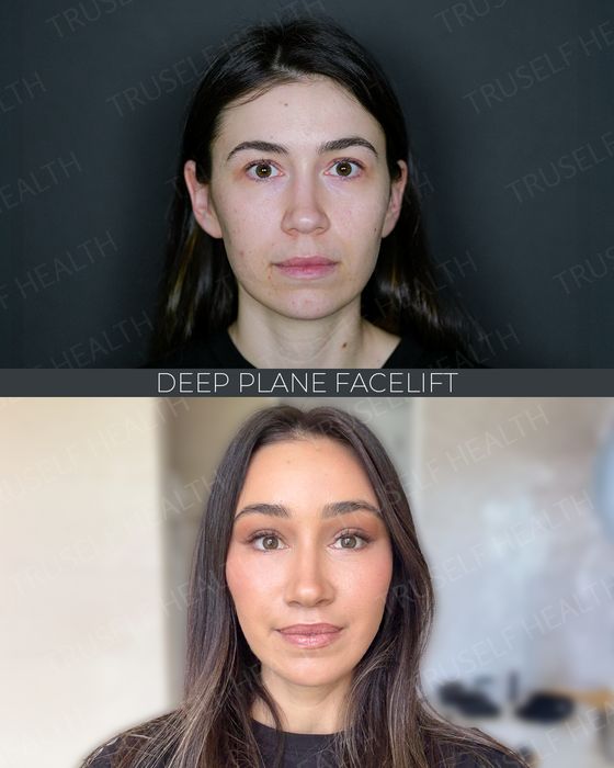 Facial Rejuvenation before and after