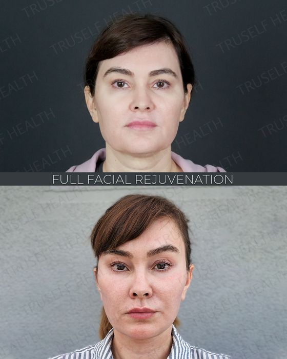 Facial Rejuvenation before and after