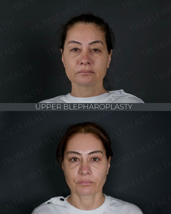 Facial Rejuvenation before and after