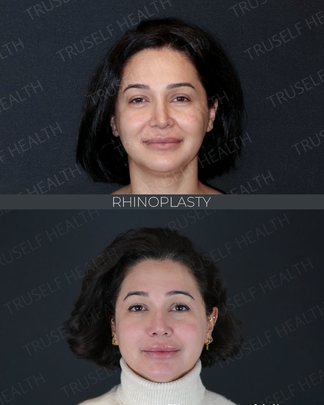 Rhinoplasty result